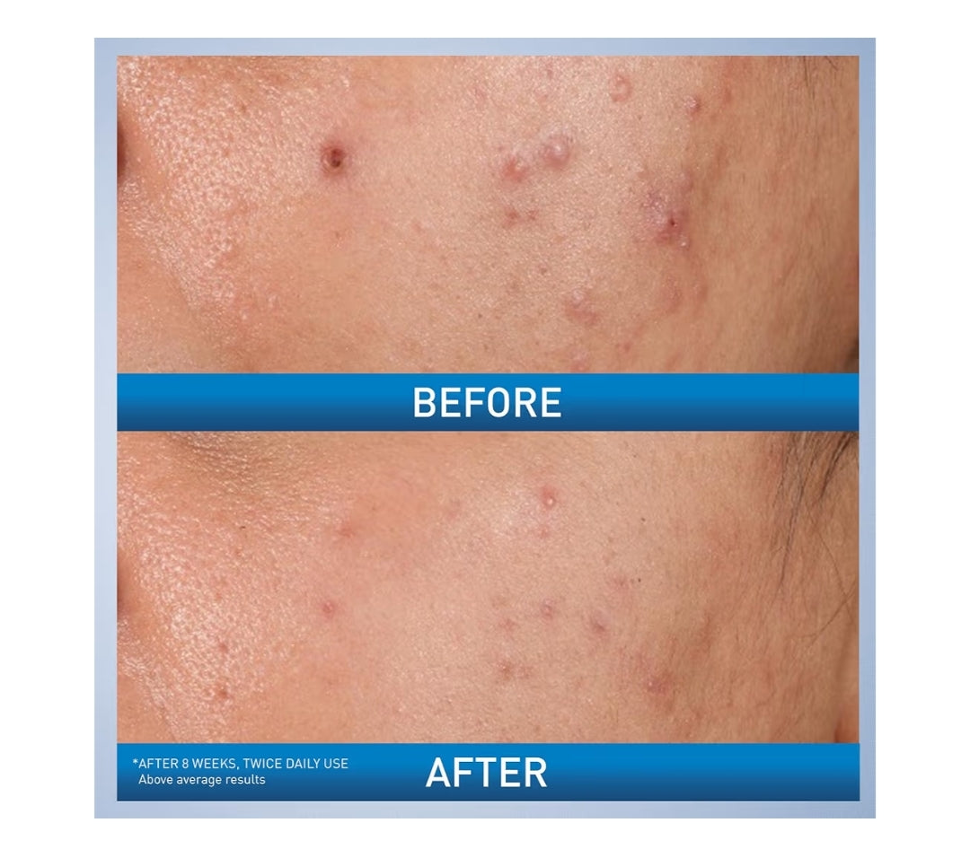CeraVe Acne Control Gel, 2% Salicylic Acid Treatment w/ Glycolic Acid + Lactic Acids, Alcohol Free & Oil Free (1.35 Fl Oz)