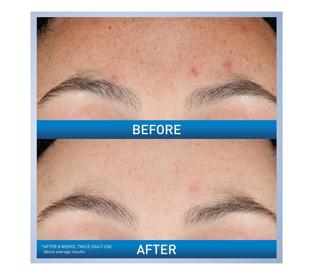 CeraVe Resurfacing Retinol Serum Formulated w/ Licorice Root Extract & Niacinamide,Non-Comedogenic